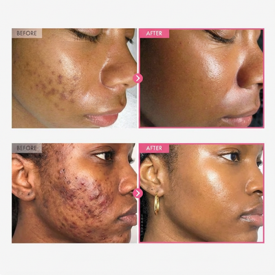 Hydressa™ Revival ToneCorrect Cream